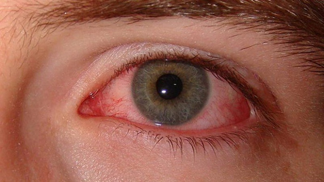 Kırmızı göz hastalığı nedir? Kırmızı göz hastalığı nasıl bulaşır?
