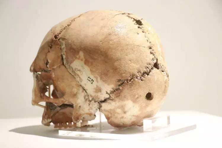 Dünyada bir ilk! İlk beyin ameliyatına ait kafatası Türkiye’de bulundu tam 10 bin 500 yıllık